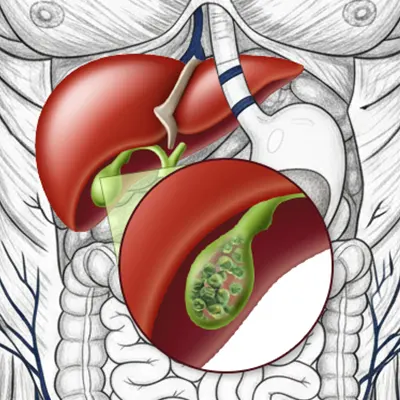 Img-Dr_Adolfo_Uribe-Cirugia de vesicula