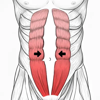 Img-Dr_Adolfo_Uribe-Diastasis de recto