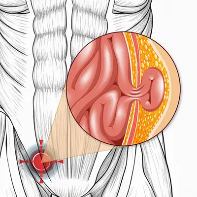 Img-Dr_Adolfo_Uribe-Hernia Inguinal - Umbilical