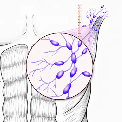 Img-Dr_Adolfo_Uribe-Sudoracción Excesiva - Hiperhidrosis